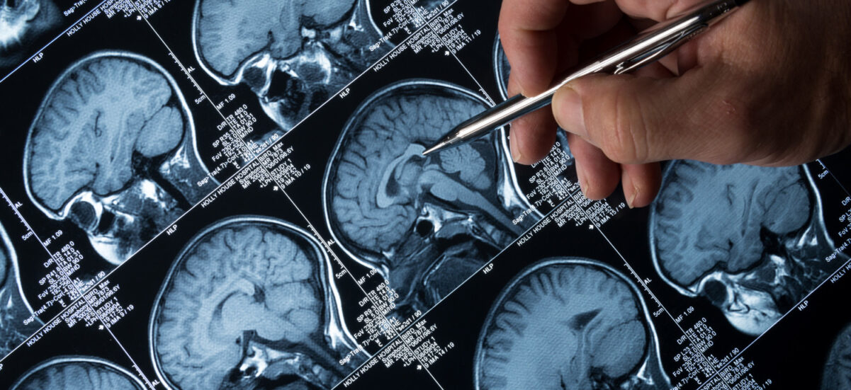 Lucid Dreaming: How Science Discovered a Third State of Brain Activity